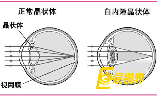  春節(jié)過量飲酒最傷眼  易視界