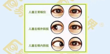 先天性斜視病因及發(fā)病機(jī)制