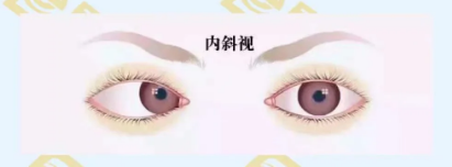 什么是調節(jié)性內斜視？