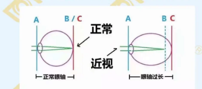哪個(gè)年齡近視度數(shù)最容易增長(zhǎng)？